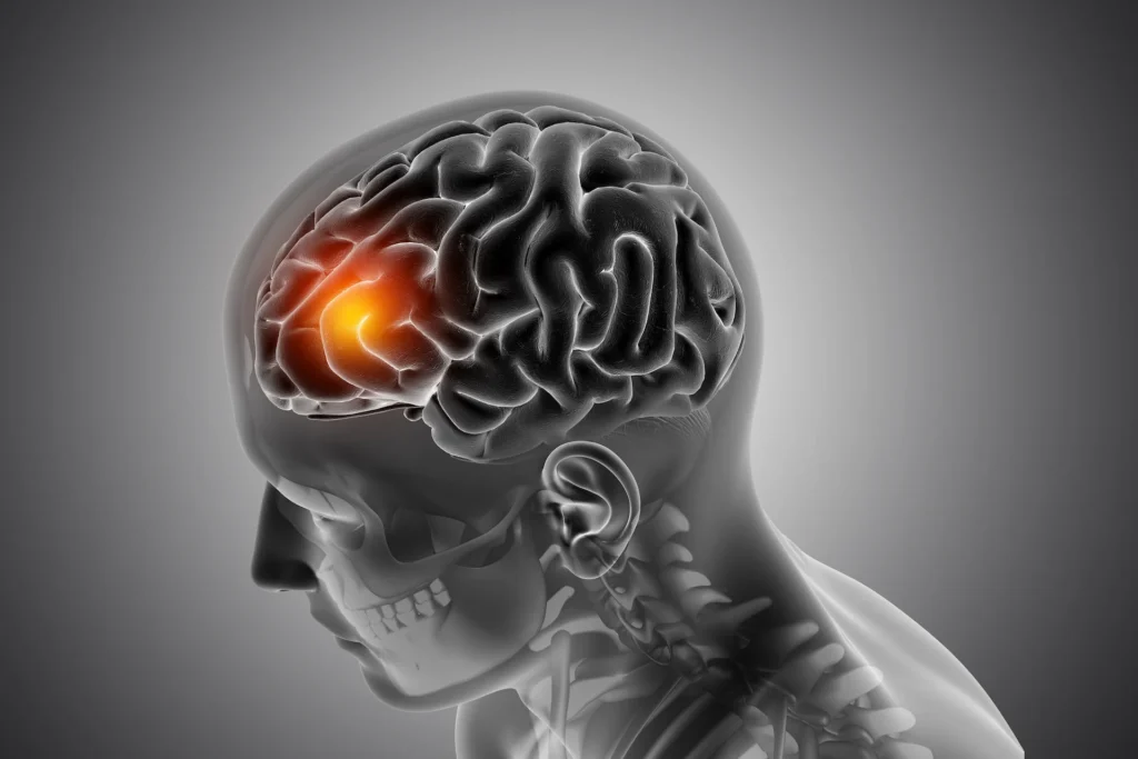 A 3D medical illustration of a human head in profile, showing a translucent skull and a dark gray brain. A specific area in the left frontal lobe of the brain glows bright orange-red.